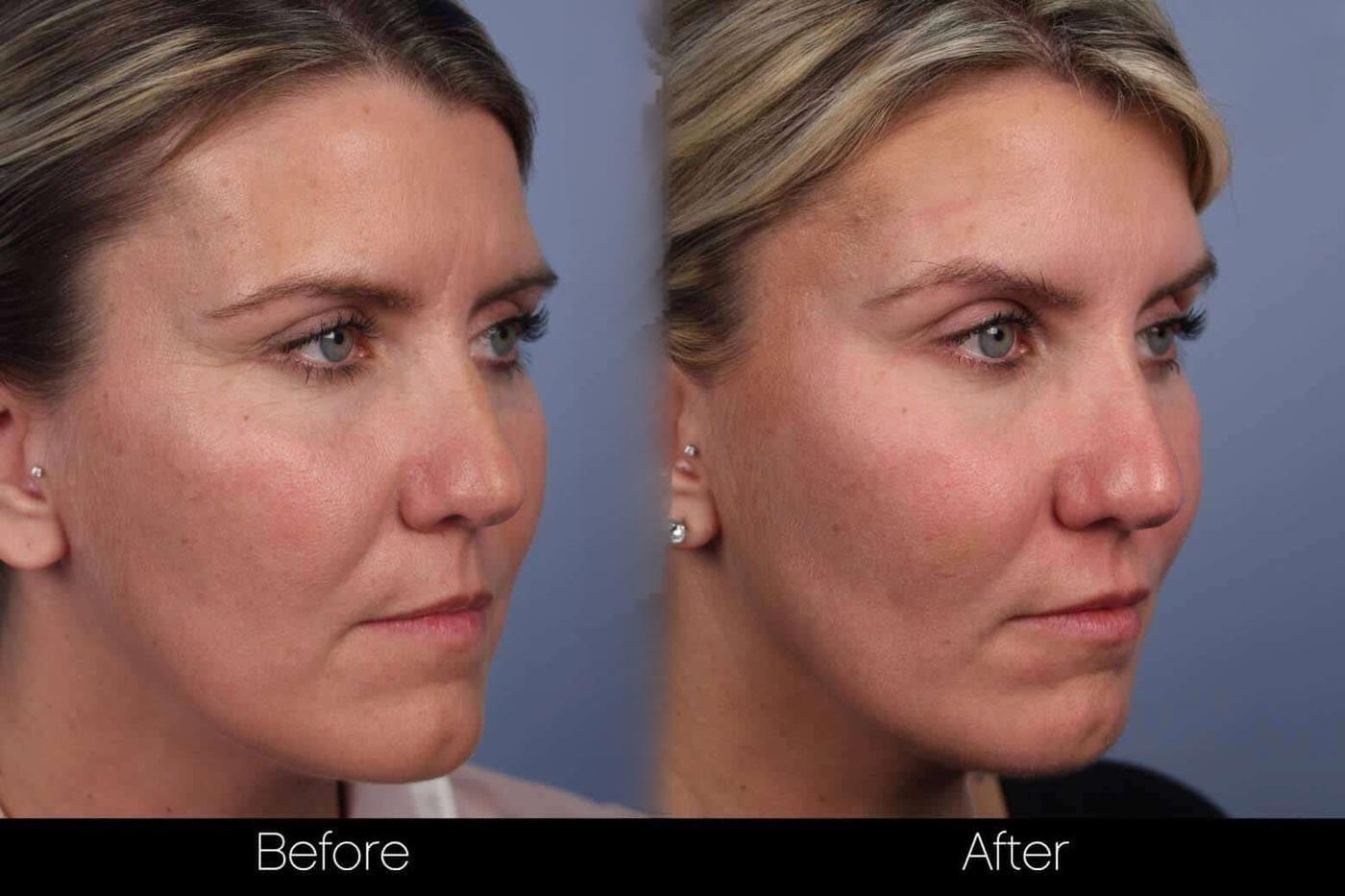 Dermal Fillers Before and After Gallery – Photo 66