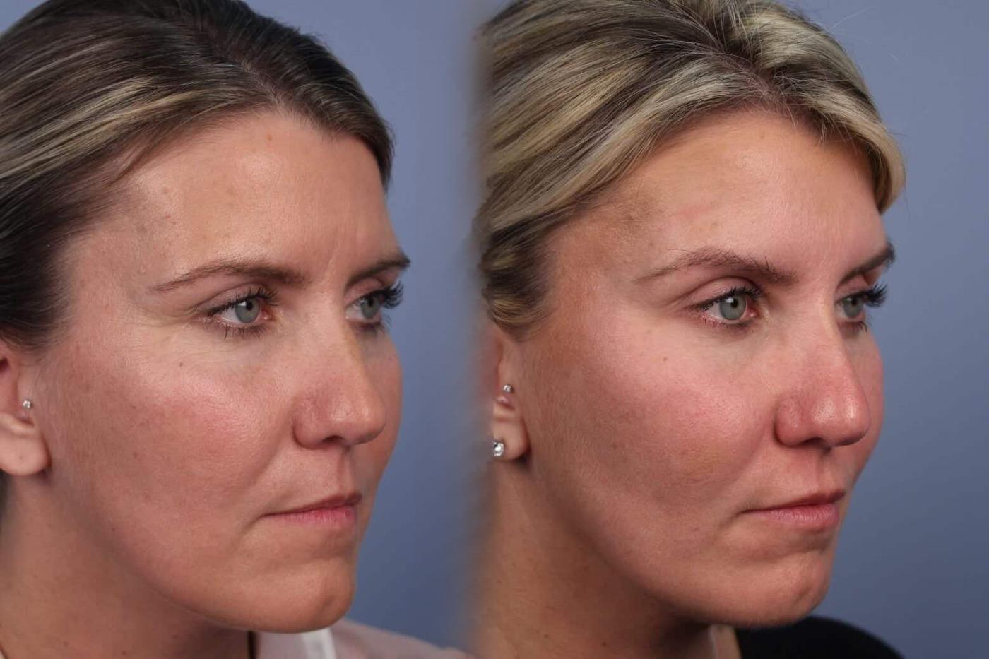 Dermal Fillers Before and After Gallery – Photo 65