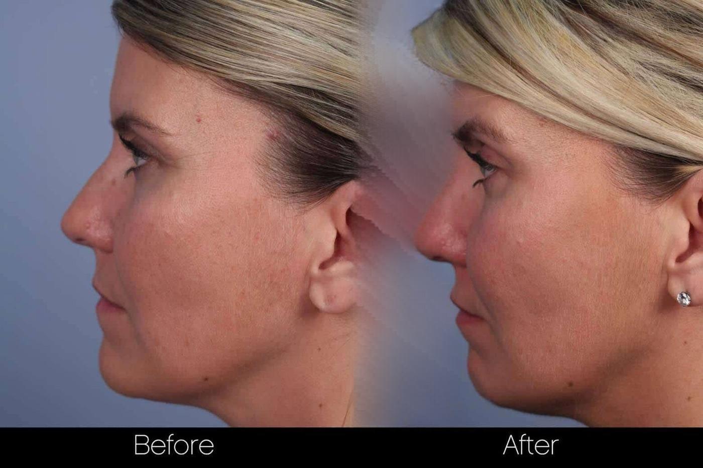 Dermal Fillers Before and After Gallery – Photo 64