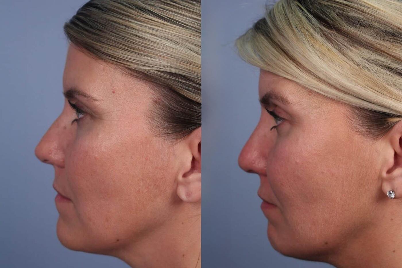 Dermal Fillers Before and After Gallery – Photo 63