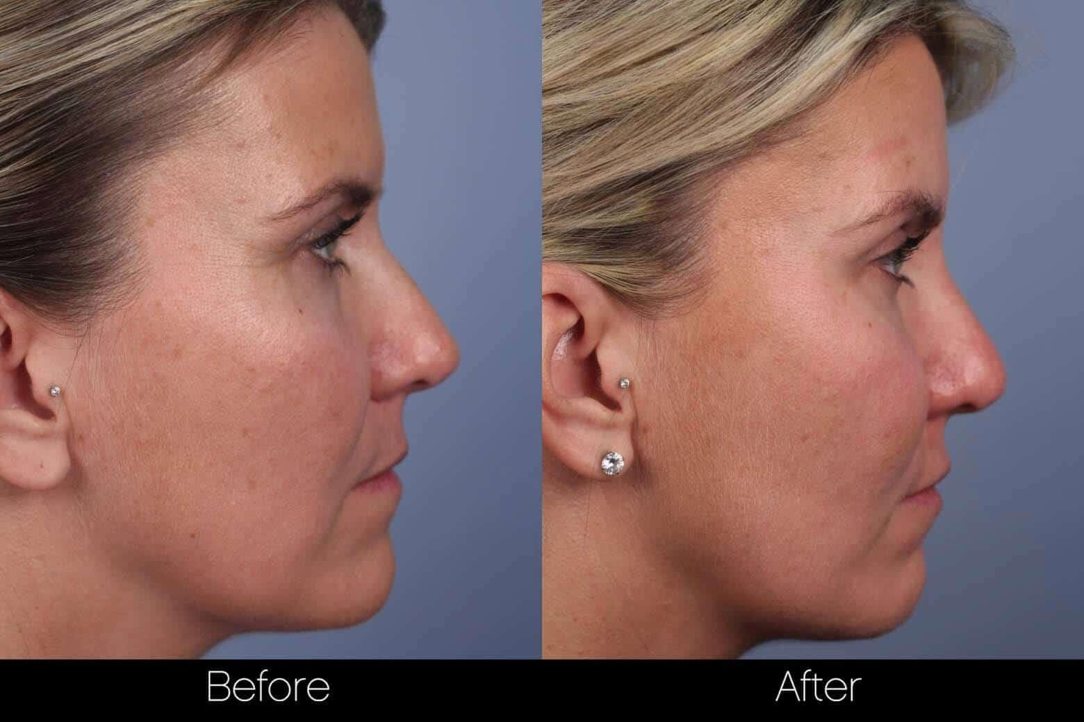 Dermal Fillers Before and After Gallery – Photo 62