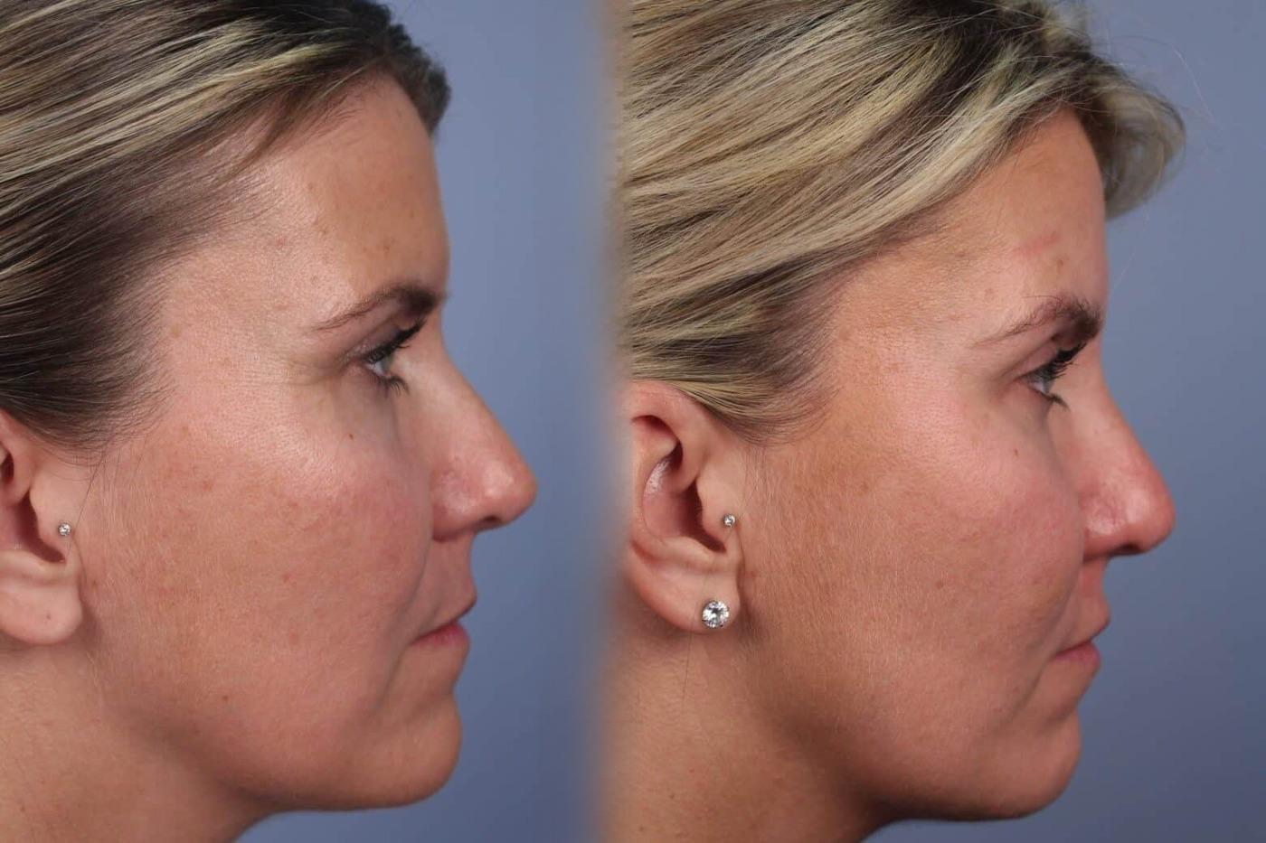 Dermal Fillers Before and After Gallery – Photo 61