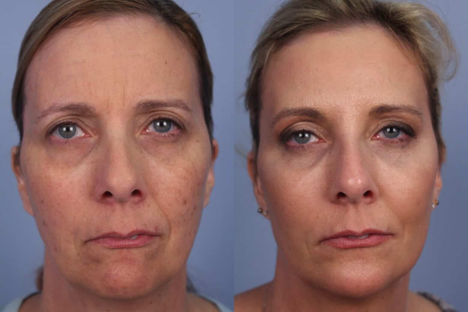Dermal Fillers Before and After Gallery – Photo 59