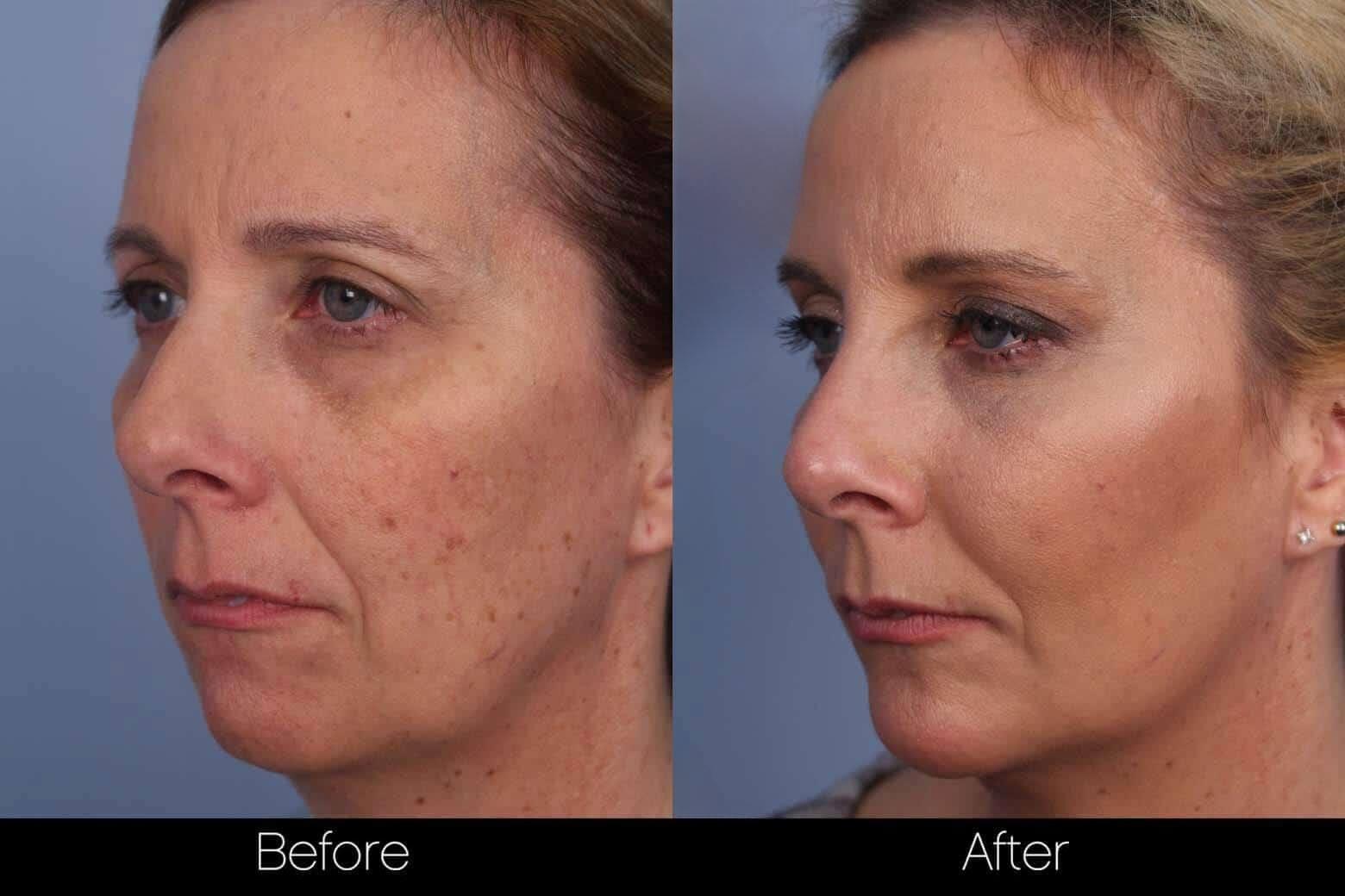 Dermal Fillers Before and After Gallery – Photo 58