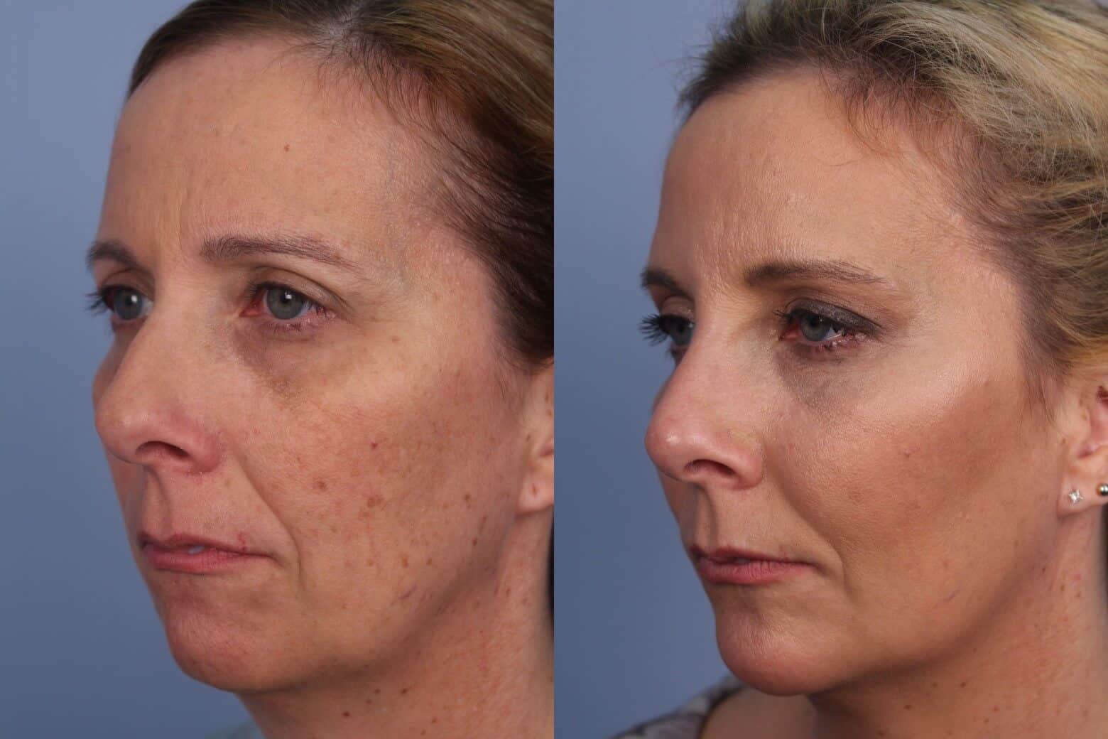 Dermal Fillers Before and After Gallery – Photo 57