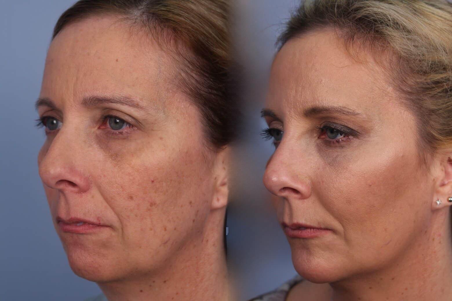 Dermal Fillers Before and After Gallery – Photo 57