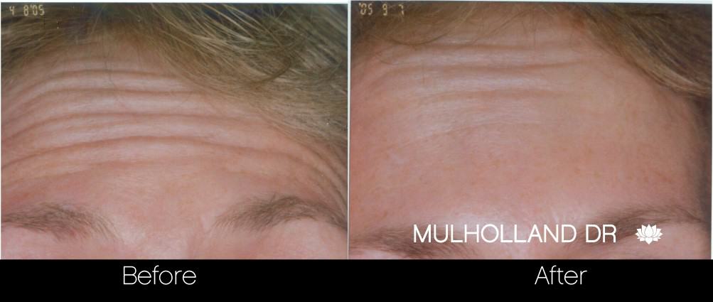 Botox Before and After Gallery - Photo 11