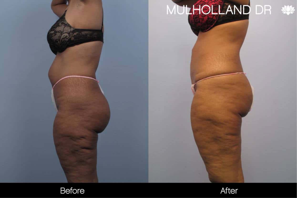 Cellulite Reduction Before and After Gallery – Photo 41