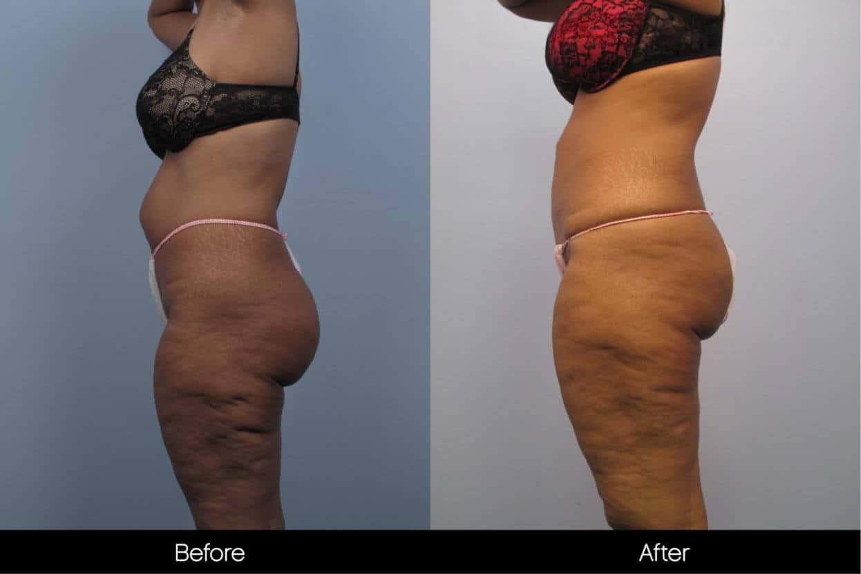 Cellulite Reduction Before and After Gallery – Photo 41