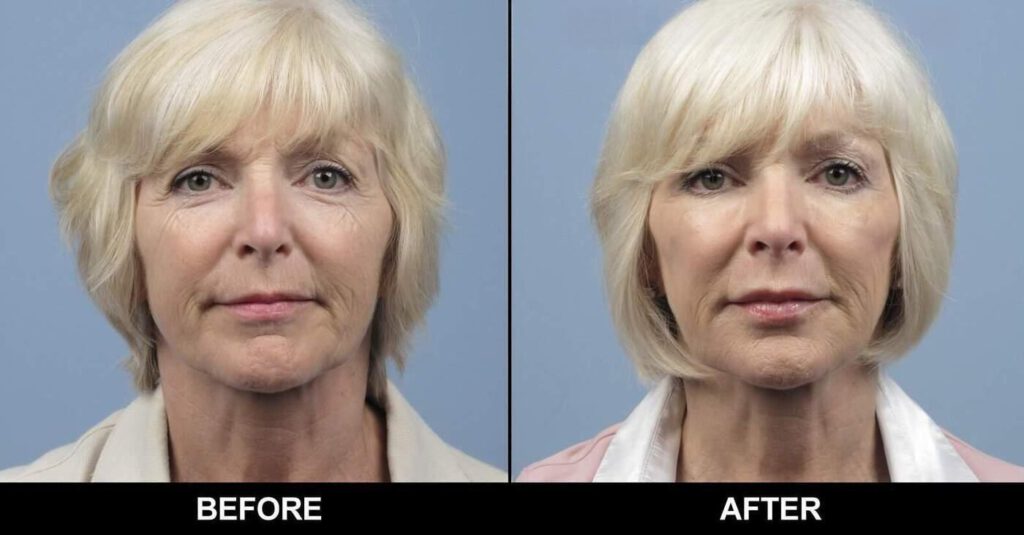 Fractional CO2 Laser Before & After Gallery SpaMedica