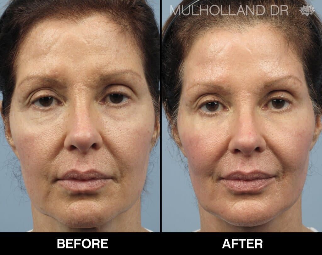 Dermal Fillers Before and After Gallery – Photo 136