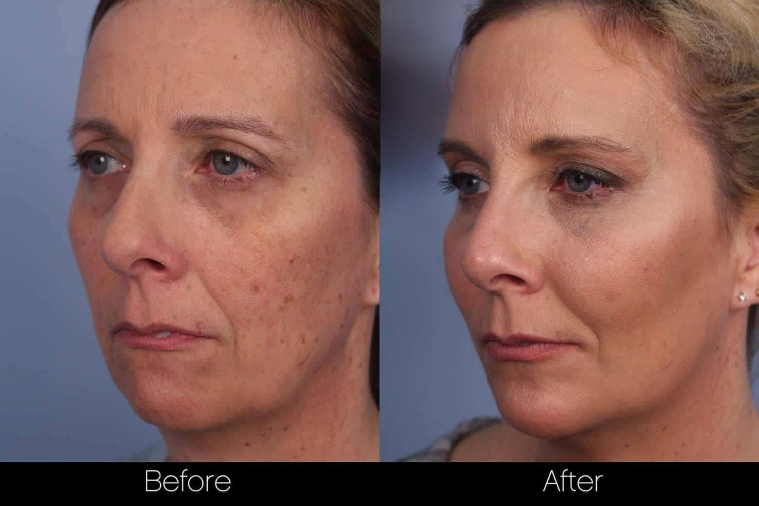 Dermal Fillers Before and After Gallery – Photo 56