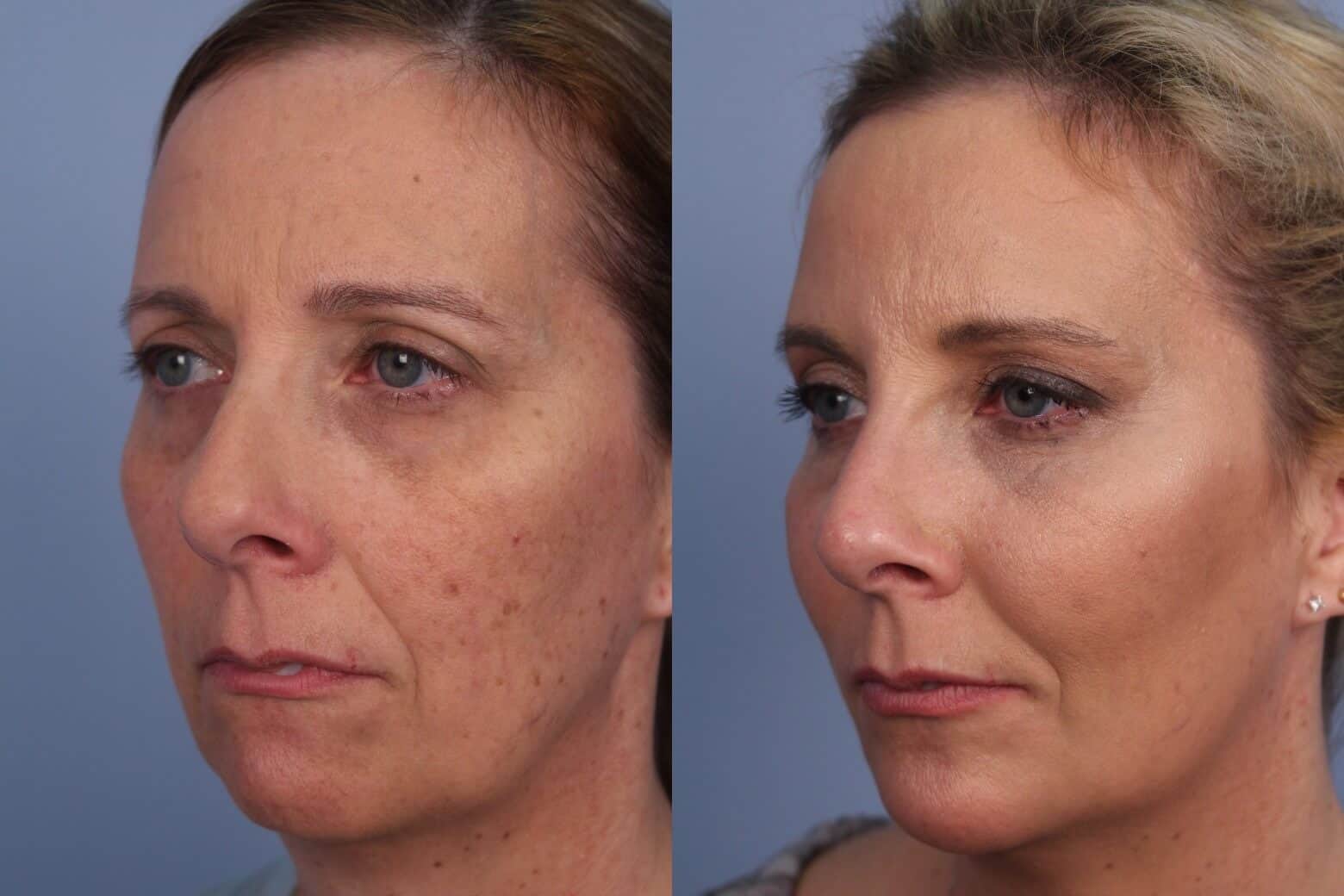 Dermal Fillers Before and After Gallery – Photo 55