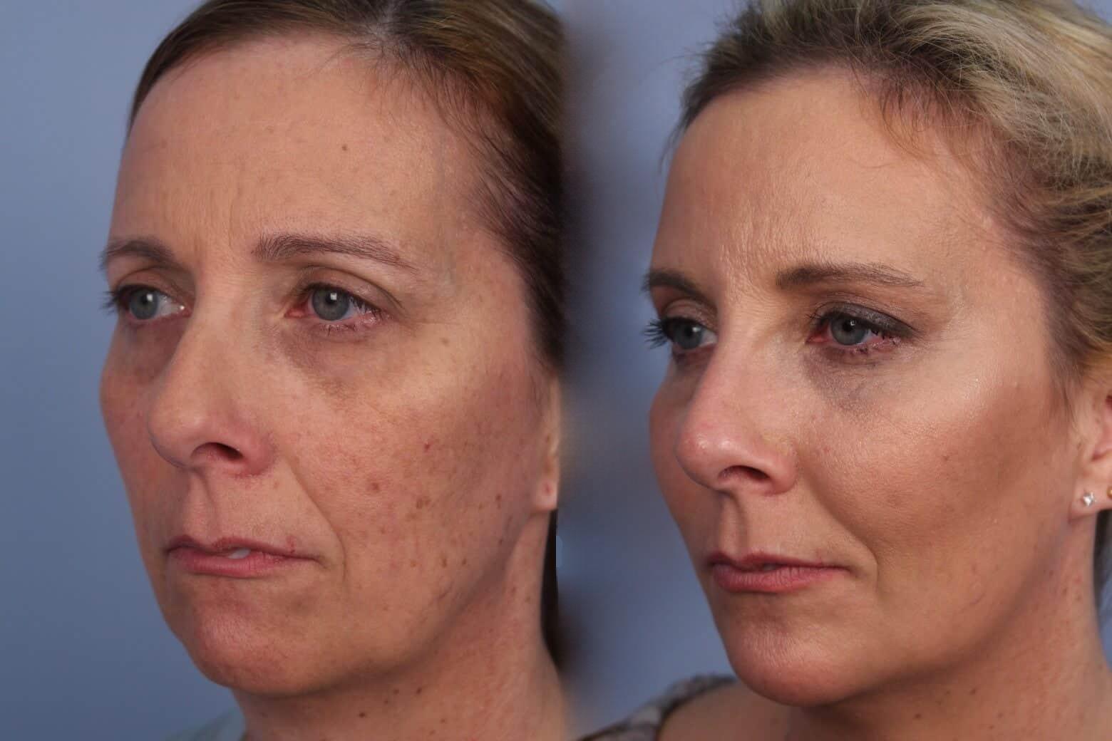Dermal Fillers Before and After Gallery – Photo 55