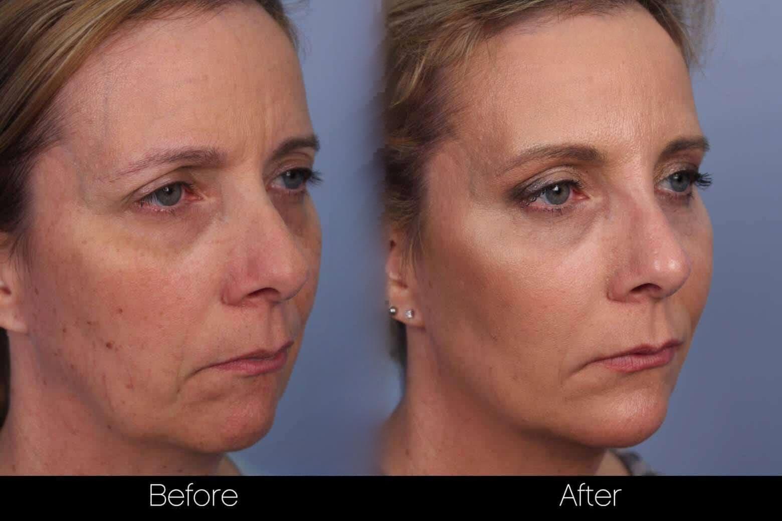 Dermal Fillers Before and After Gallery – Photo 54
