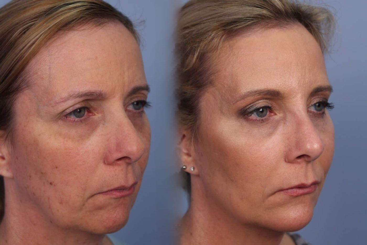 Dermal Fillers Before and After Gallery – Photo 53