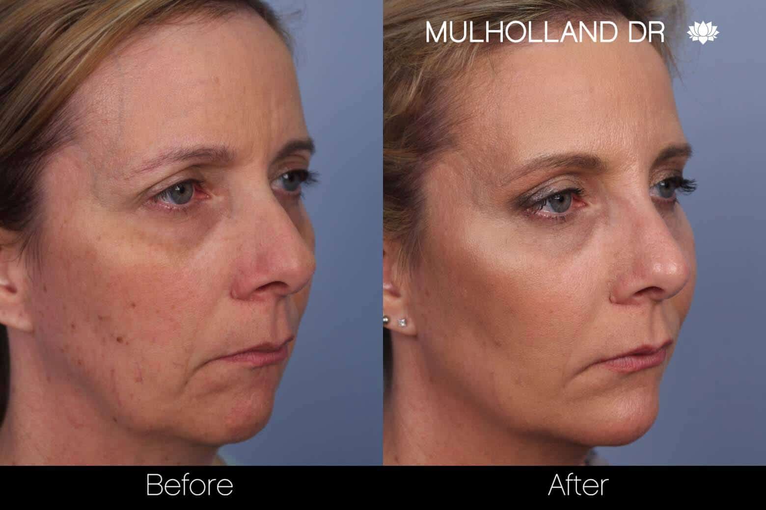 Dermal Fillers Before and After Gallery – Photo 52