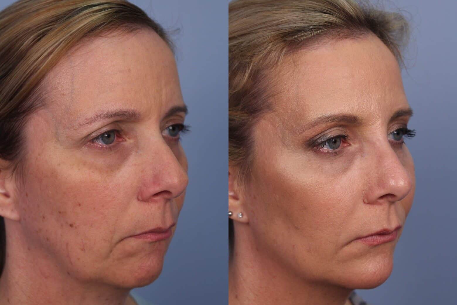 Dermal Fillers Before and After Gallery – Photo 51