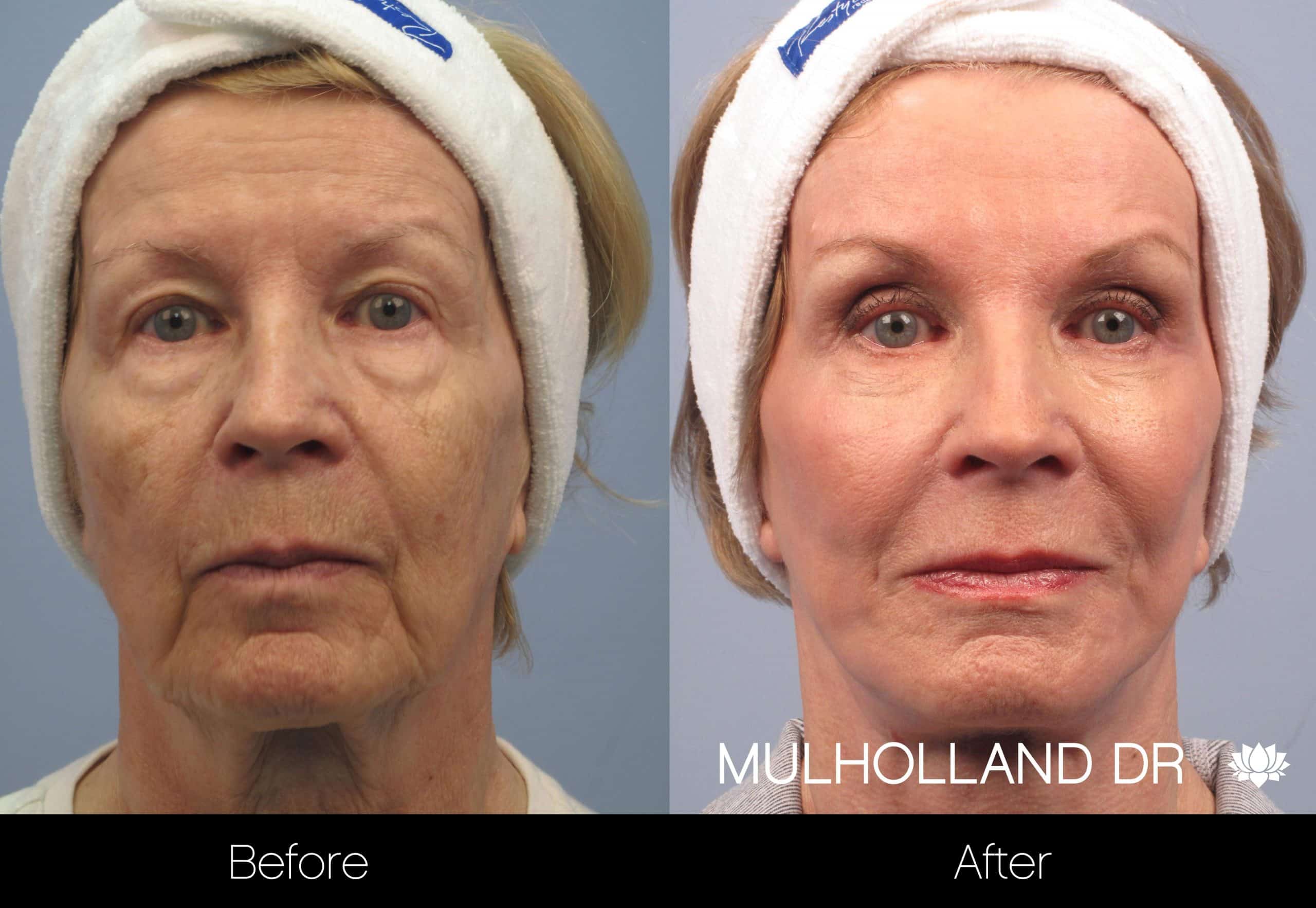 Facelift Before and After Gallery – Photo 2