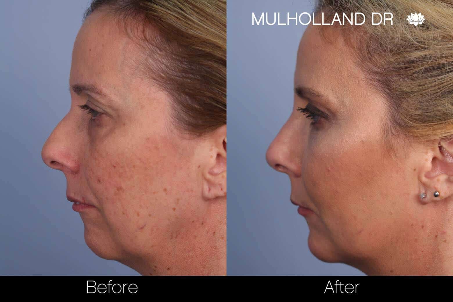 Dermal Fillers Before and After Gallery – Photo 50