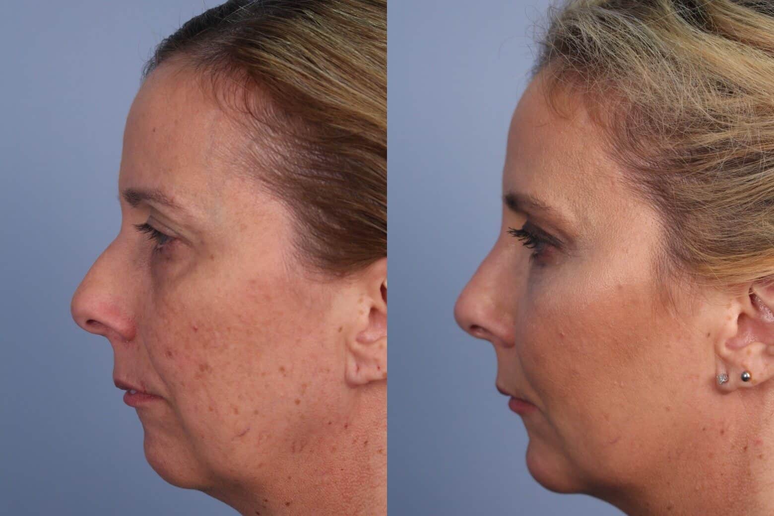 Dermal Fillers Before and After Gallery – Photo 49