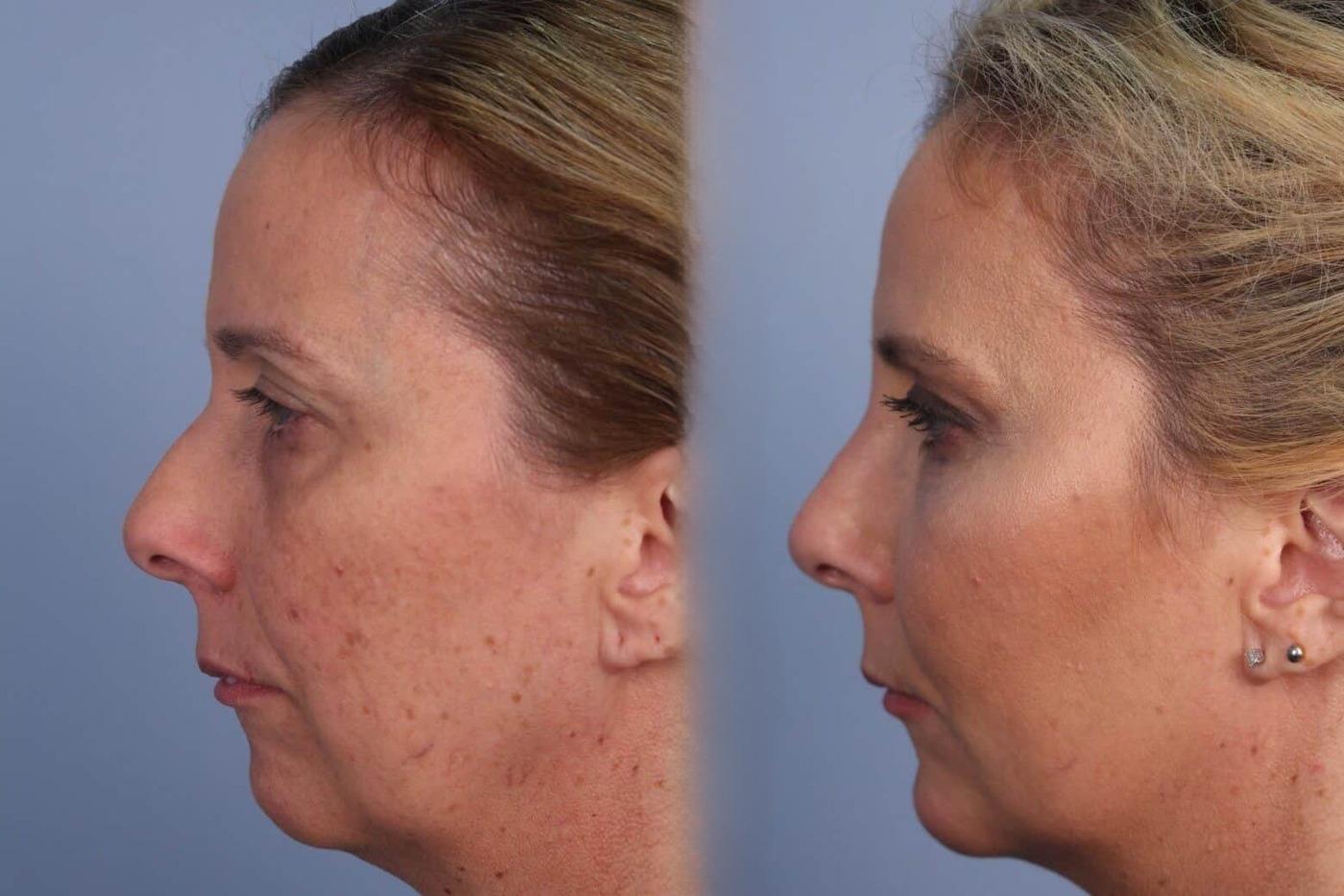Dermal Fillers Before and After Gallery – Photo 49