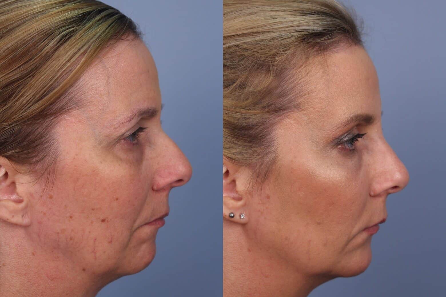 Dermal Fillers Before and After Gallery – Photo 47