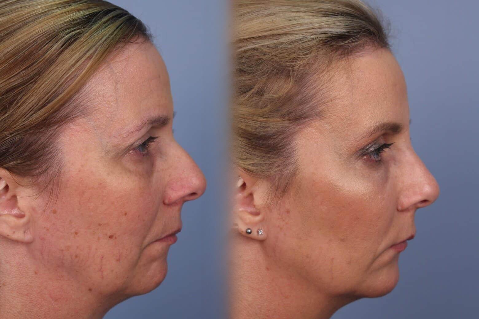 Dermal Fillers Before and After Gallery – Photo 47