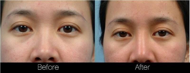 5 Minute Nose Job - Before and After Gallery – Photo 10