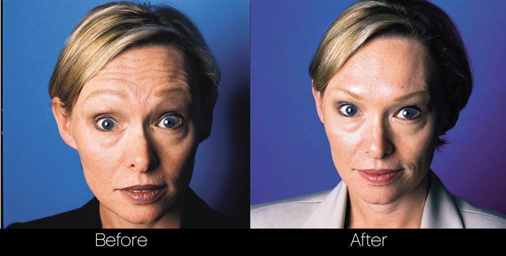 Botox Injectable - Before and After Gallery – Photo 10