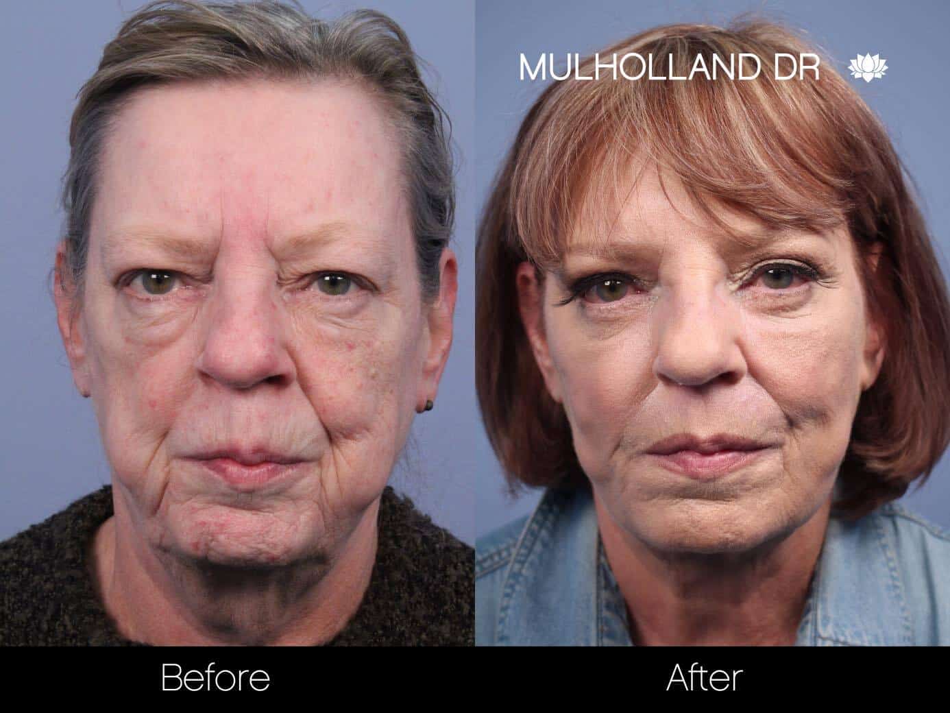 Non-Surgical Facelift - Before and After Gallery – Photo 10