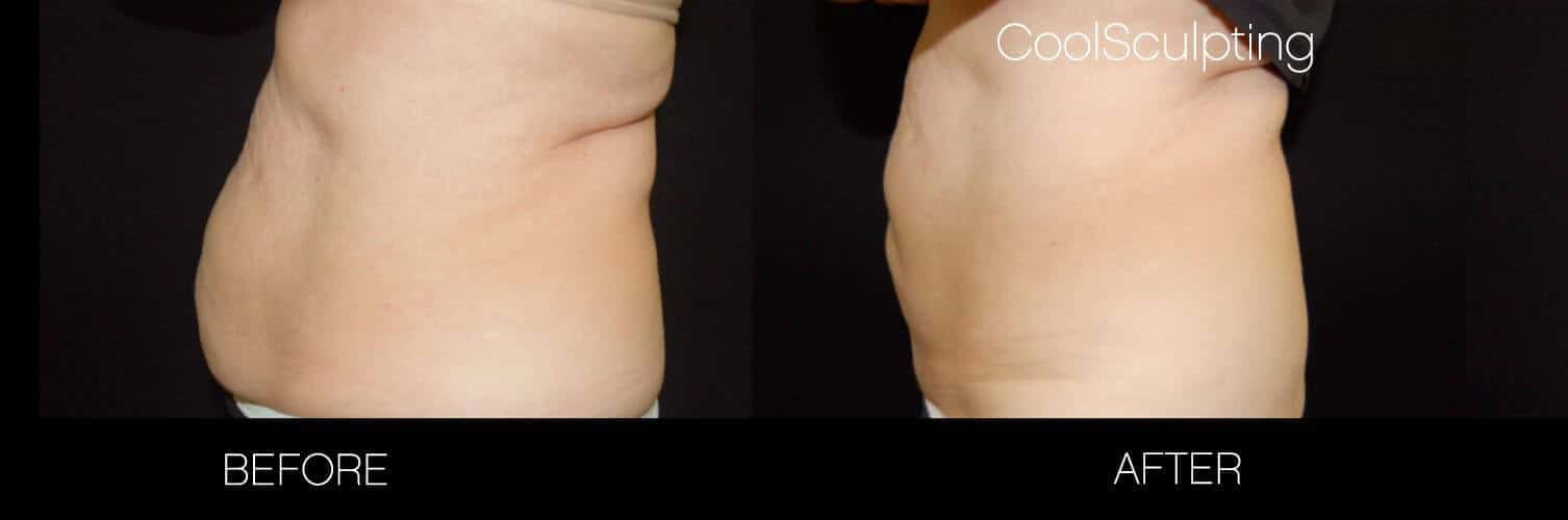 CoolSculpting - Before and After Gallery – Photo 10