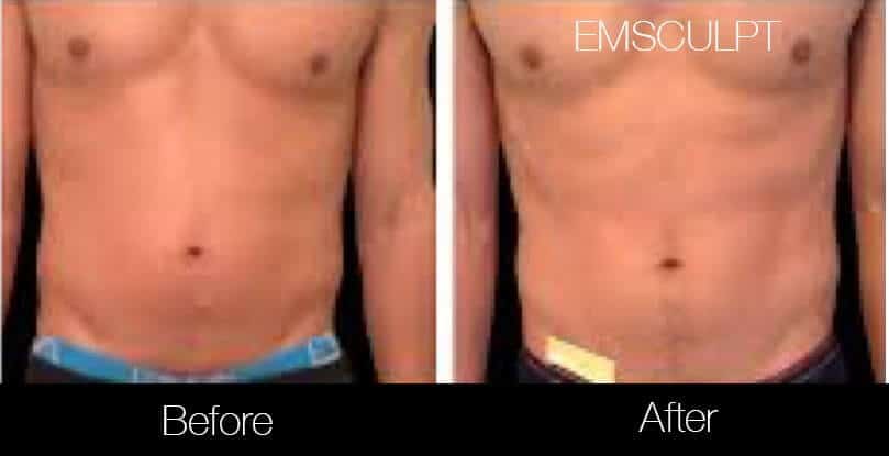 Emsculpt - Before and After Gallery – Photo 10