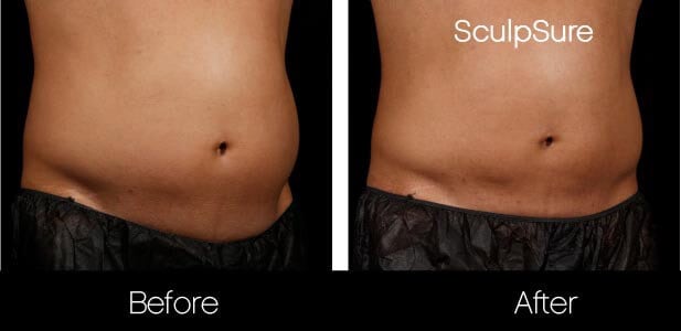 SculpSure - Before and After Gallery – Photo 11