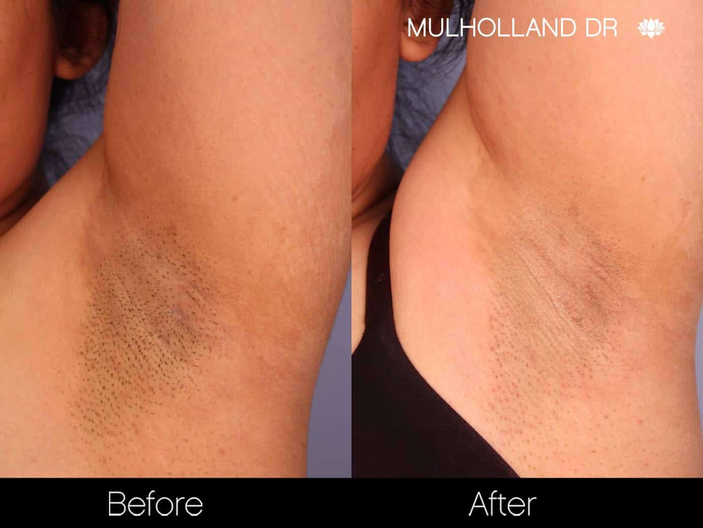 Laser Hair Removal - Patient Before and After Gallery – Photo 10