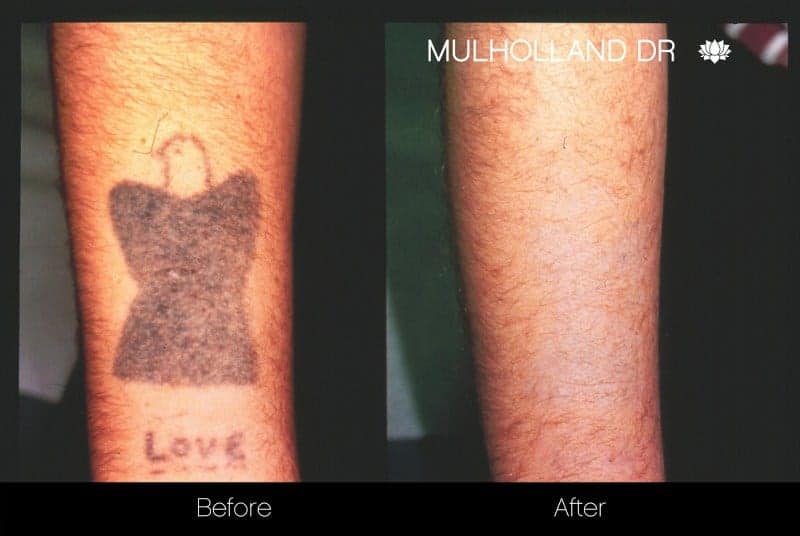 Laser Tattoo Removal in Bangalore  Laser Tattoo Removal Cost in Bangalore   Anew