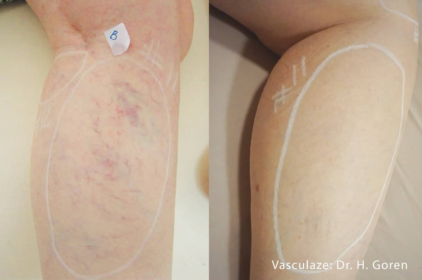 Leg Vein Reduction - Patient Before and After Gallery – Photo 10