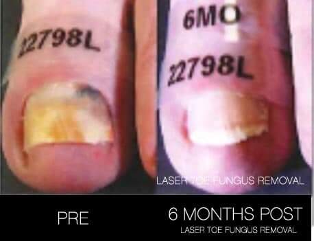 Toe Fungus Removal - Patient Before and After Gallery – Photo 10