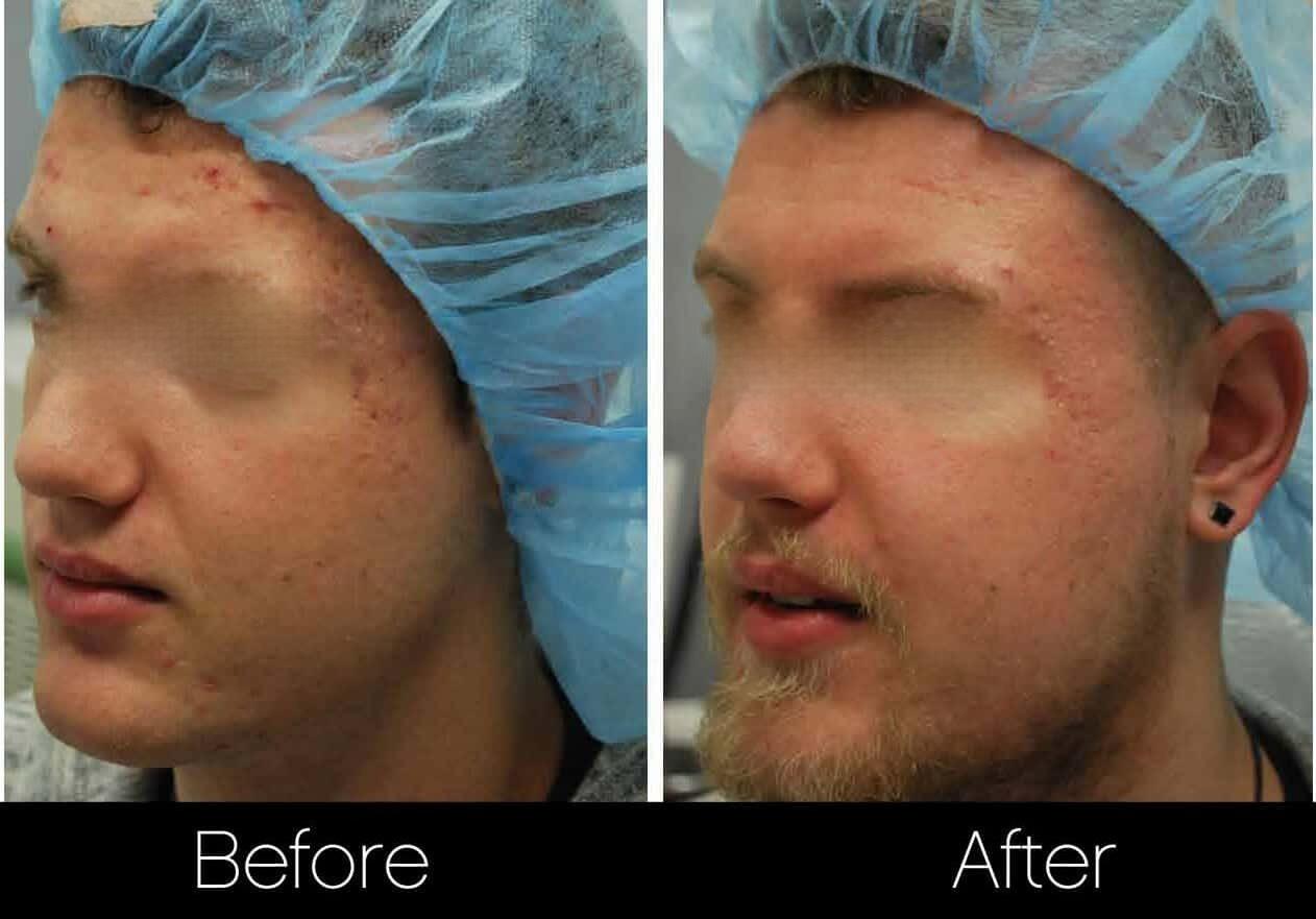 Acne Scar Treatments - Before and After Gallery – Photo 11