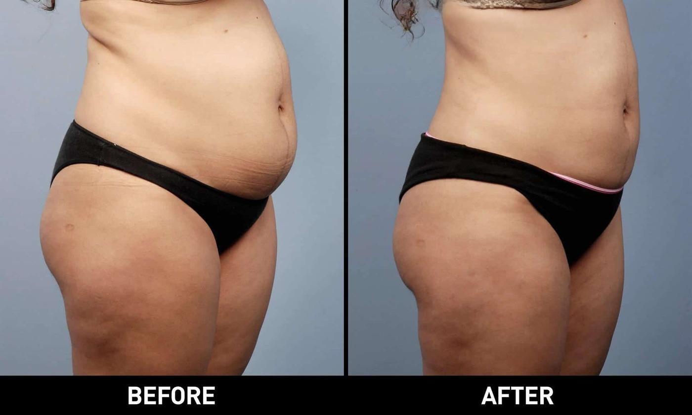 Smart Lipo - Before and After Gallery – Photo 10