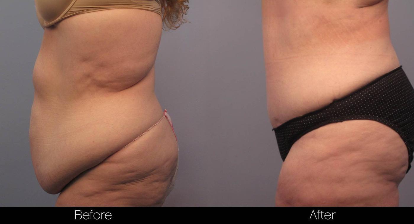 Tummy Tuck - Before and After Gallery – Photo 10