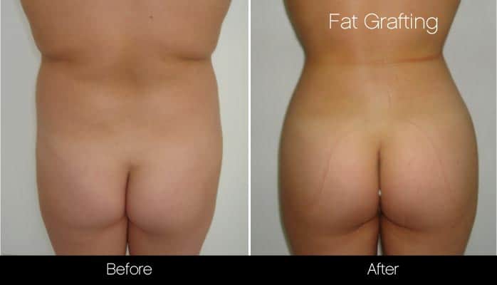 Brazilian Butt Lift - Before and After Gallery – Photo 10