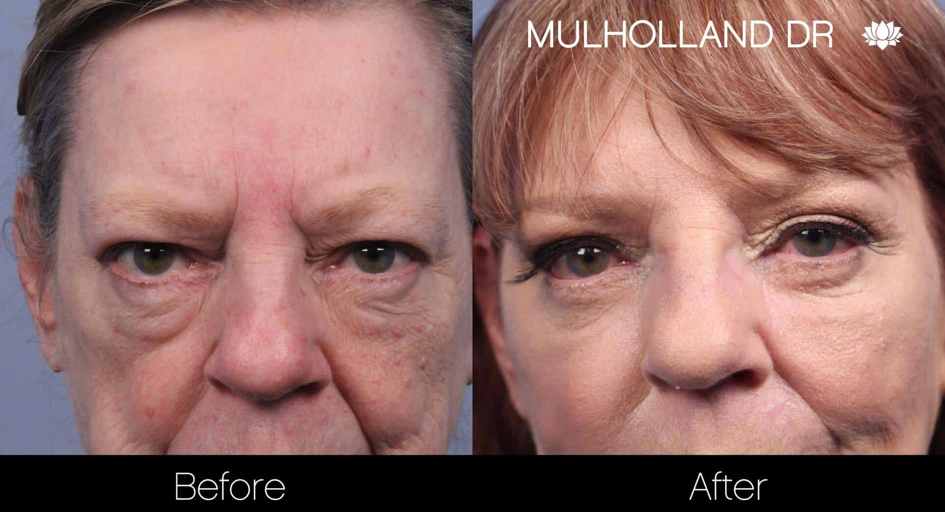 Non-Surgical Facelift - Before and After Gallery – Photo 11