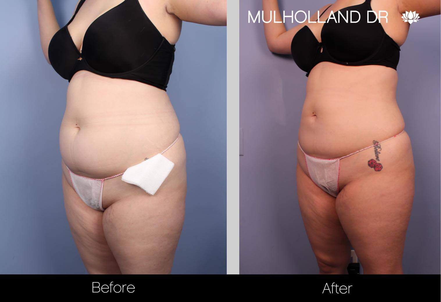 Vaser Lipo - Before and After Gallery – Photo 11