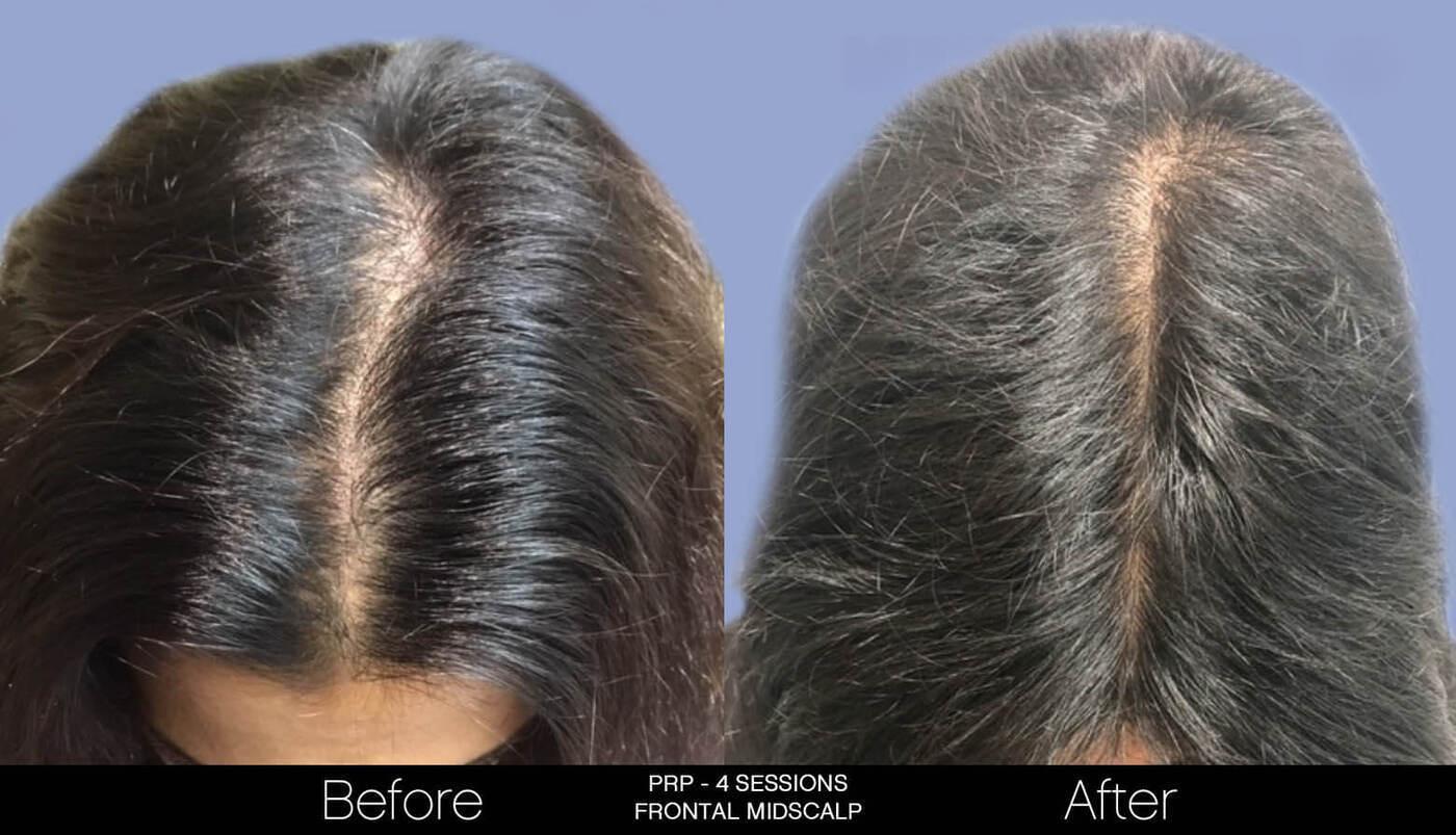 Non-Surgical Hair Restoration - Patient Before and After Gallery – Photo 11