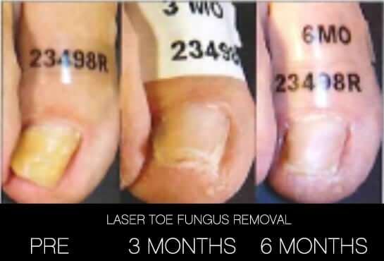 Toe Fungus Removal - Patient Before and After Gallery – Photo 11