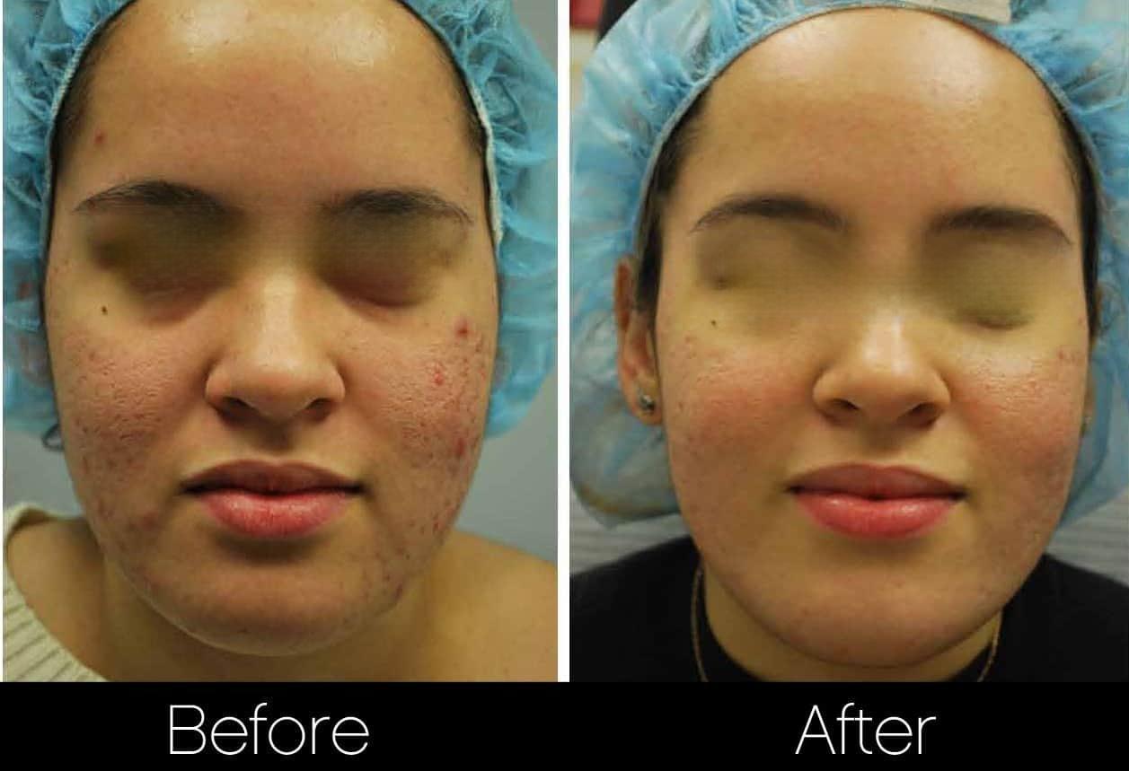Acne Scar Treatments - Before and After Gallery – Photo 5