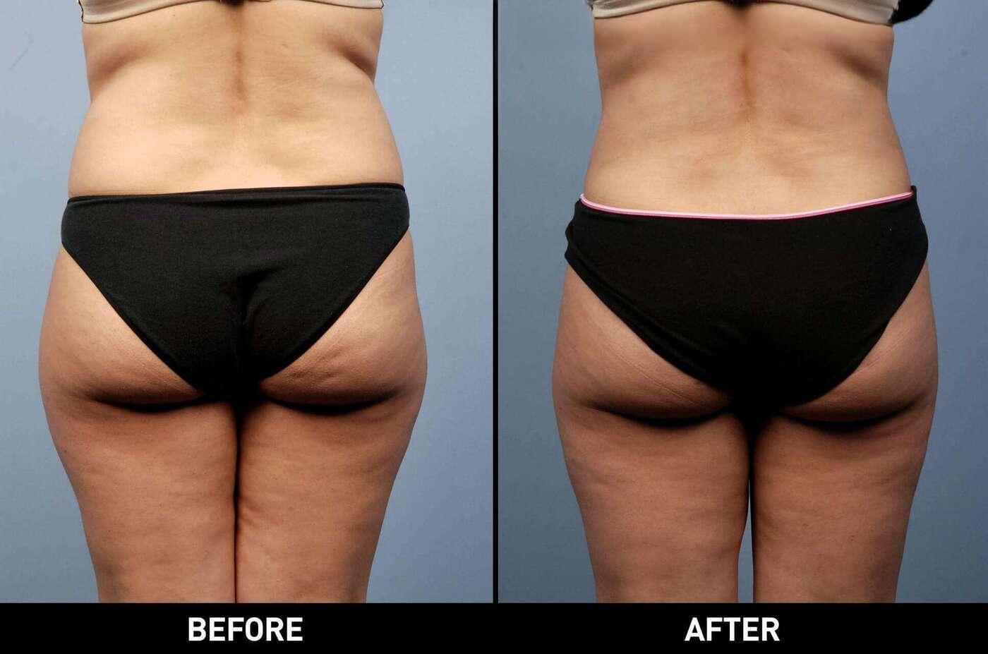 Smart Lipo - Before and After Gallery – Photo 11