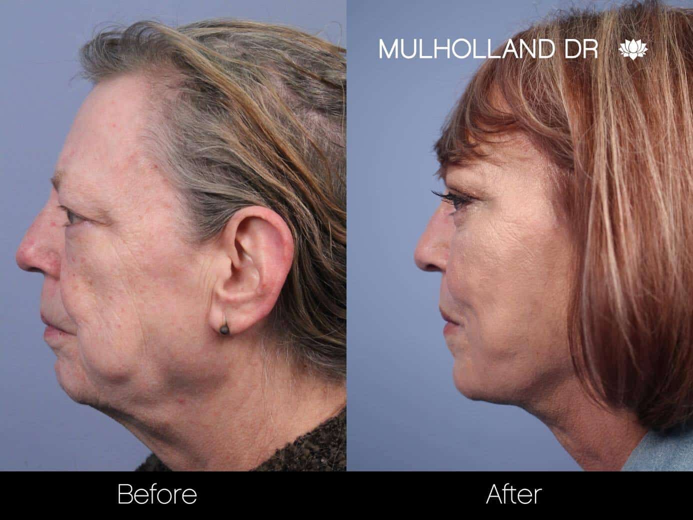 Non-Surgical Facelift - Before and After Gallery – Photo 12