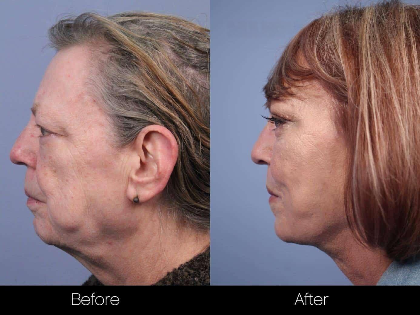 Non-Surgical Facelift - Before and After Gallery – Photo 12